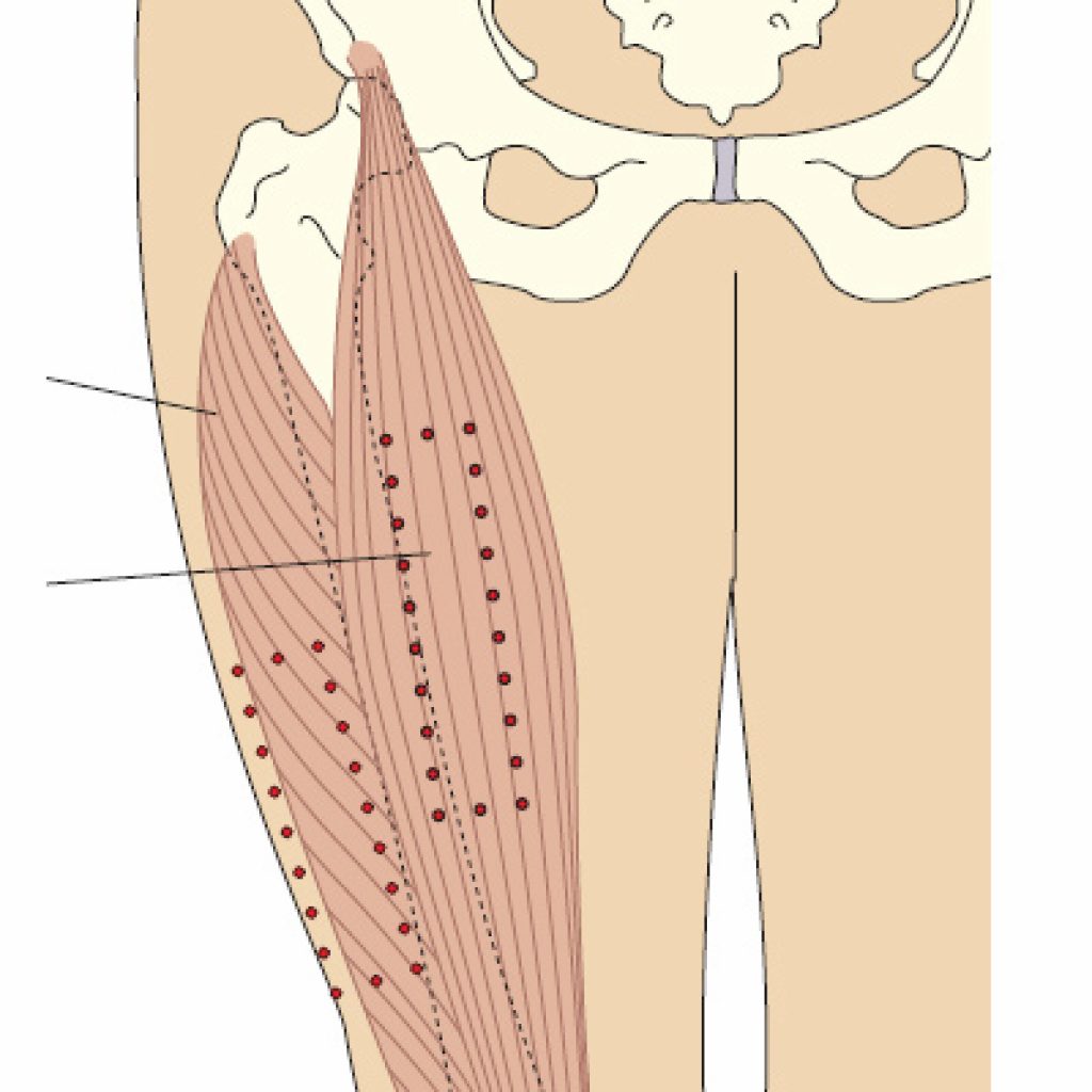 Можно колоть уколы в ногу. Передняя поверхность бедра укол внутримышечно. Верхний наружный Квадрант бедра. Внутримышечная инъекция места введения бедро. Наружная поверхность бедра внутримышечная инъекция.