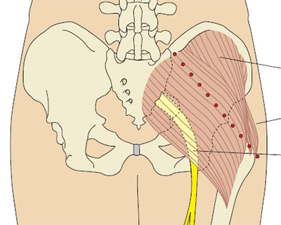 Большая ягодичная мышца: места для внутримышечных инъекций