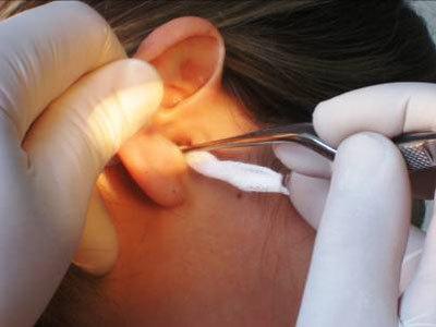 Закладывание мази в ухо