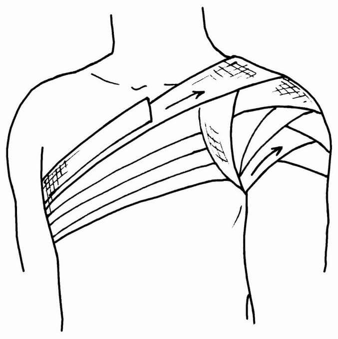 Типы бинтовых повязок: колосовидная на плечо