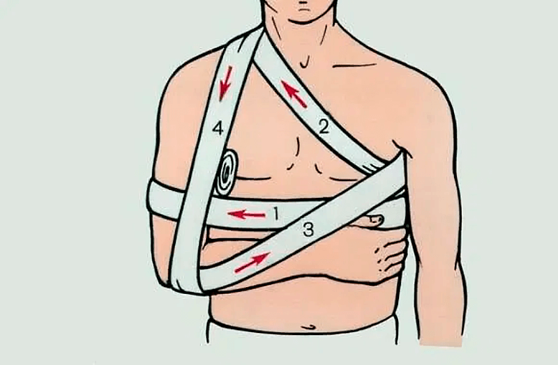 Повязка Дезо на плечевой сустав: показания, техника наложения